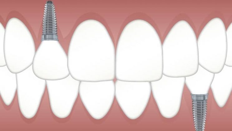 Implantes dentales en Madrid ¿Cómo elegir la mejor clínica de implantes?